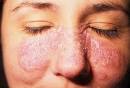 Diagnosing <b>lupus</b> is a very