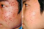 Acne Philadelphia Acne Treatment Main Line - acne-before-and-after