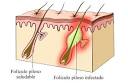 <b>Foliculitis</b>
