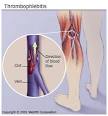 With <b>thrombophlebitis</b>