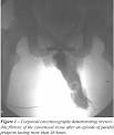 <b>Priapism</b>. Causes, symptoms, treatment <b>Priapism</b>