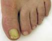 Distal subungual <b>onychomycosis</b>