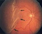 <b>Retinal Detachment</b>: Imaging of Surgical Treatments and Complications1