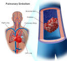 of a pulmonary embolism