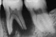 Lateral <b>root resorption</b> may