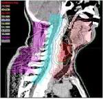 <b>Cancer</b> of the <b>hypopharynx</b> is