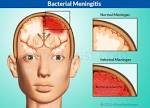 Bacterial Meningitis|Causes|Risk Factors|Symptoms|Diagnosis.