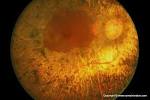High Omega-3 Boosts Vitamin A Effect in <b>Retinitis Pigmentosa</b>