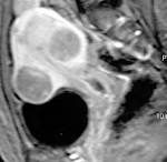 <b>Uterine cervicitis</b>.