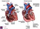 Qué es <b>Hipertensión Pulmonar</b>