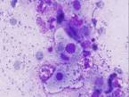 (<b>granuloma inguinale</b>) in a