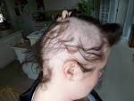 SWIGCHD.com <b>Alopecia Areata</b> is