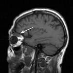 <b>Erdheim</b>-<b>Chester Disease</b>