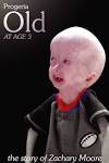 <b>Progeria</b>
