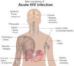 File:Symptoms of acute <b>HIV</b>