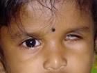 Microphthalmia