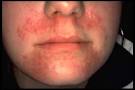 <b>Dermatite Irritative</b>