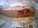Esthétique - <b>Mucormycose</b>