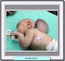 El <b>encefalocele</b> es un defecto