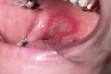 <b>granuloma</b>, central giant cell,