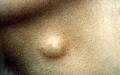 Simple epidermoid <b>cysts</b> can