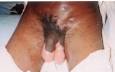 <b>Gangrena de Fournier</b>.