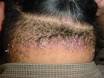 <b>Acne</b> keloidalis