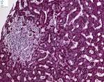 Mycobacterium avium intracellulare - Humpath.com - Human pathology
