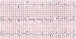 <b>Right ventricular</b> strain