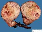 <b>Wilms tumor</b> - Humpath.com