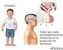 <b>Hipersecreción</b> De La <b>Hormona</b>