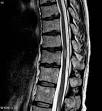 Transverse <b>myelitis</b> (the