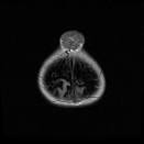 <b>Sinus pericranii</b>