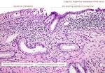 Squamous <b>metaplasia</b> of the cervix