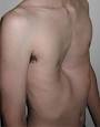 An example of a severe case.