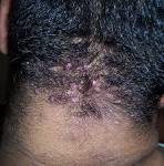 <b>Acne</b> keloidalis nuchae =العد