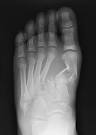 Expert Insights On Detecting Lisfranc's Injuries | Podiatry Today
