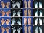 <b>Syndactyly</b>.