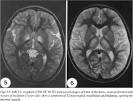 <b>Kearns</b>-<b>Sayre syndrome</b>