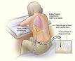 <b>Pleurisy</b> - Wikipedia, the free