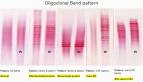 have <b>oligoclonal</b> IgG <b>bands</b>