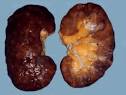 Hypertensive <b>nephrosclerosis</b>