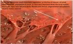 <b>rheumatic fever</b> )