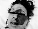 des cas de <b>mucormycose</b>