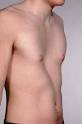 Pectus excavatum (<b>funnel chest</b>