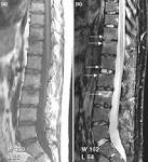 File:<b>Psoriatic arthritis</b> spine