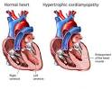 Heart Surgery markedly improve symptoms and afford normal longevity