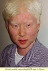 Albino pronunciation