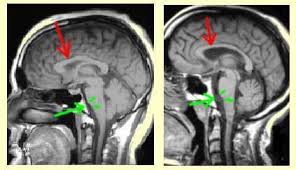 Healthy brain/brain from obese person