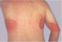 your <b>radiation injuries</b>.